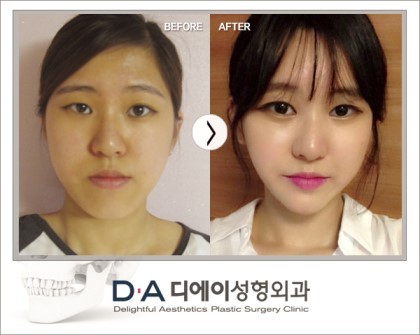 그 유명한 양악수술 | 인스티즈
